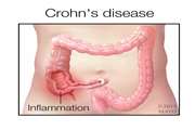 Stem cell transplants to be used in treating Crohn's disease