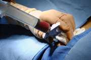 Bone marrow transplants have best quality of life outcomes, patients report